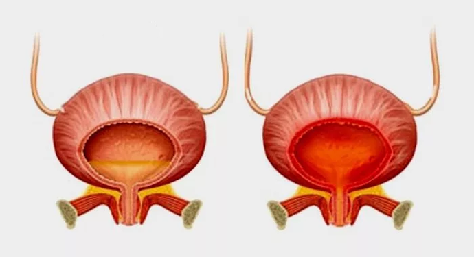 Normal Blase (lénks) an Entzündung vun der Blase mat Cystitis (riets)